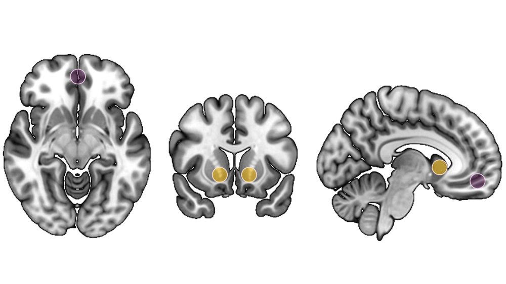 Brain images of the valuation system: the nucleus accumbens and the medial prefrontal cortex